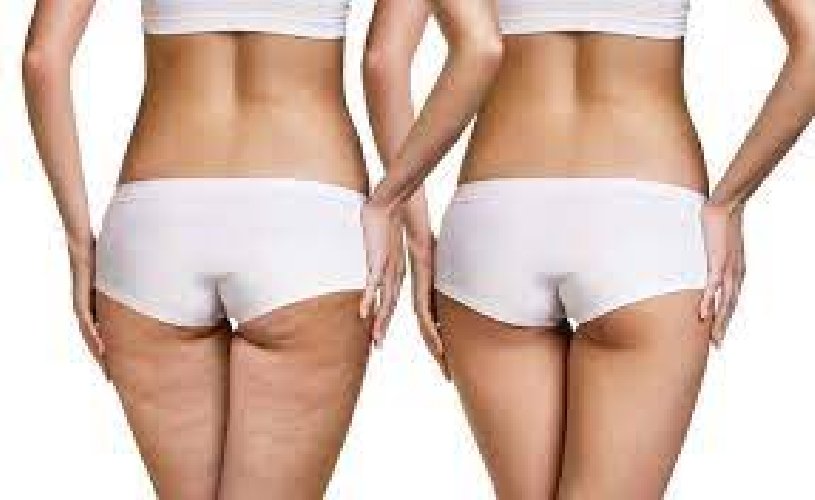 https://www.ragusanews.com/immagini_articoli/09-05-2021/cellulite-cause-e-rimedi-migliori-per-combatterla-500.jpg