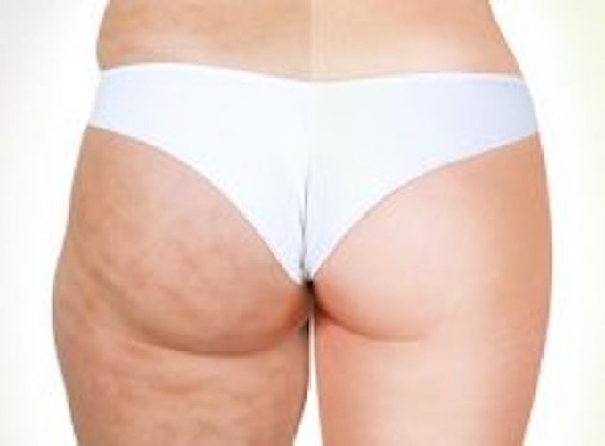 https://www.ragusanews.com/immagini_articoli/25-01-2021/killer-il-rimedio-naturale-anti-cellulite-fai-da-te-500.jpg