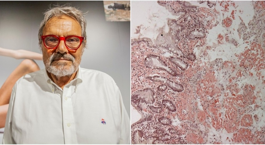 https://www.ragusanews.com/immagini_articoli/29-08-2024/oliviero-toscani-e-l-amiloidosi-nuovo-farmaco-spazzino-500.jpg