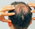 https://www.ragusanews.com/immagini_articoli/31-07-2023/perdita-dei-capelli-nuova-cura-per-l-alopecia-areata-100.jpg