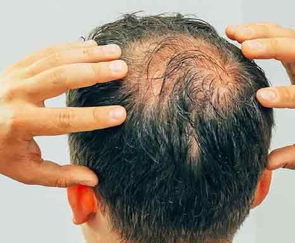 https://www.ragusanews.com/immagini_articoli/31-07-2023/perdita-dei-capelli-nuova-cura-per-l-alopecia-areata-500.jpg