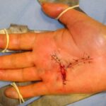 Operazione alla mano