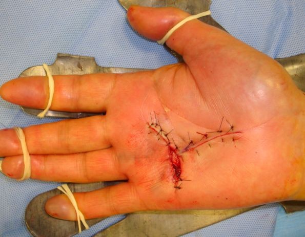 Si trancia un dito, lo porta all’ospedale e se lo fa riattaccare