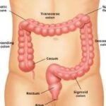 Tumore al colon