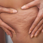 Come combattere la cellulite