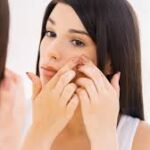 La dieta anti acne