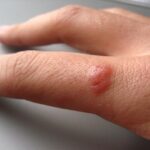 Come eliminare i porri e le verruche dalla pelle con i rimedi naturali