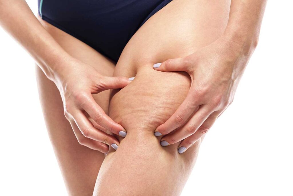 I rimedi migliori per combattere la cellulite