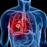 Cancro ai polmoni, nuovo farmaco cala 80% rischio di recidiva o morte