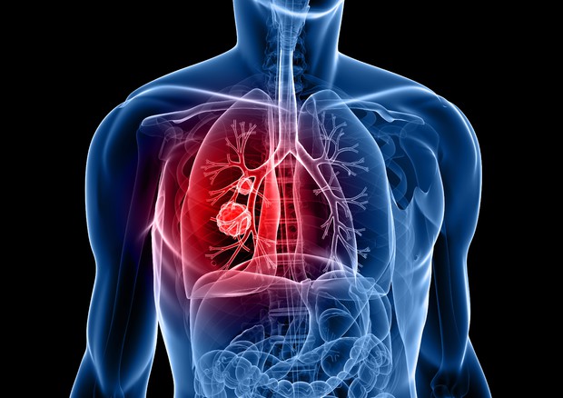Cancro ai polmoni, nuovo farmaco cala 80% rischio di recidiva o morte Cancro ai polmoni, nuovo farmaco cala 80% rischio di recidiva o morte