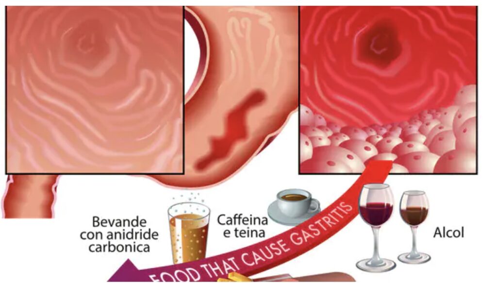 Dieta e Gastrite: come combatterla con gli alimenti giusti