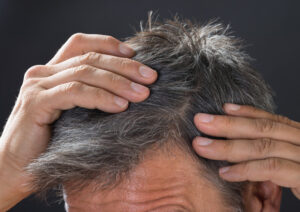 Covid, il 30% dei pazienti perde i capelli: come evitare il problema