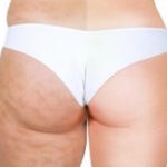 "Killer": il rimedio naturale anti cellulite fai da te