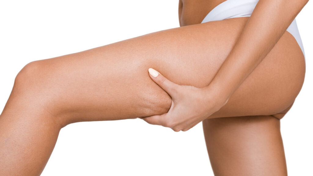 Cellulite e ritenzione idrica: ecco come prevenirle e combatterle