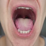 La lingua covid: ecco come si manifesta