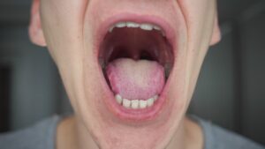 La lingua covid: ecco come si manifesta