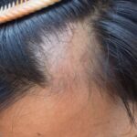 Caduta dei capelli da Covid 19: cosa fare?