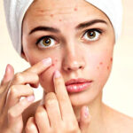 Dieta contro Acne e brufoli: consigli per un’alimentazione corretta