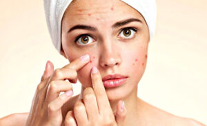 Dieta contro Acne e brufoli: consigli per un’alimentazione corretta