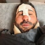 Cade con monopattino su buca a Palermo, chef Giunta in ospedale