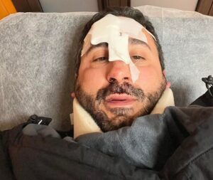 Cade con monopattino su buca a Palermo, chef Giunta in ospedale