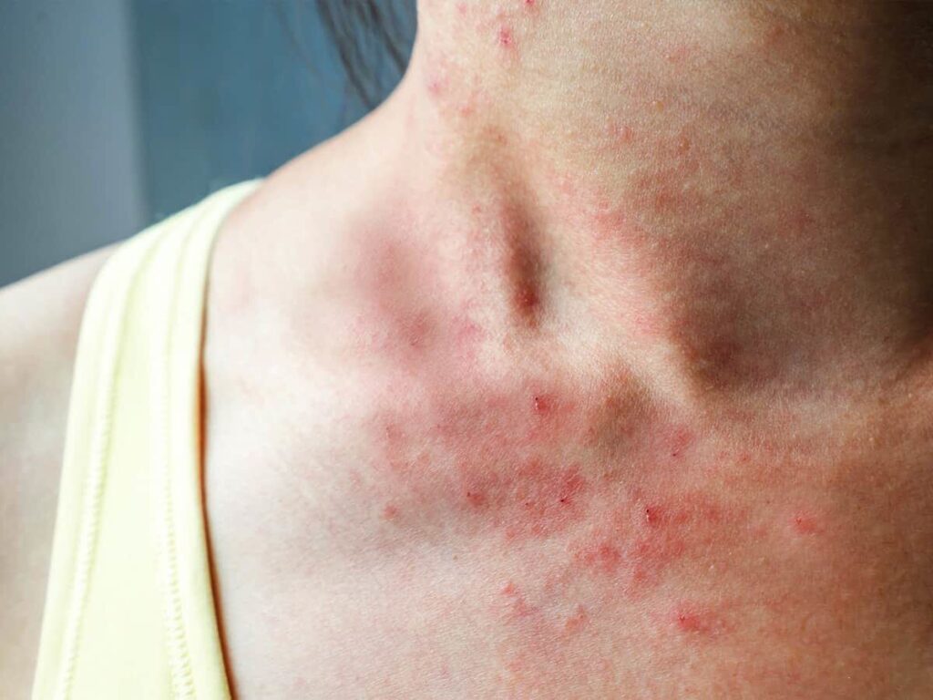 Colesterolo alto: i sintomi da non sottovalutare