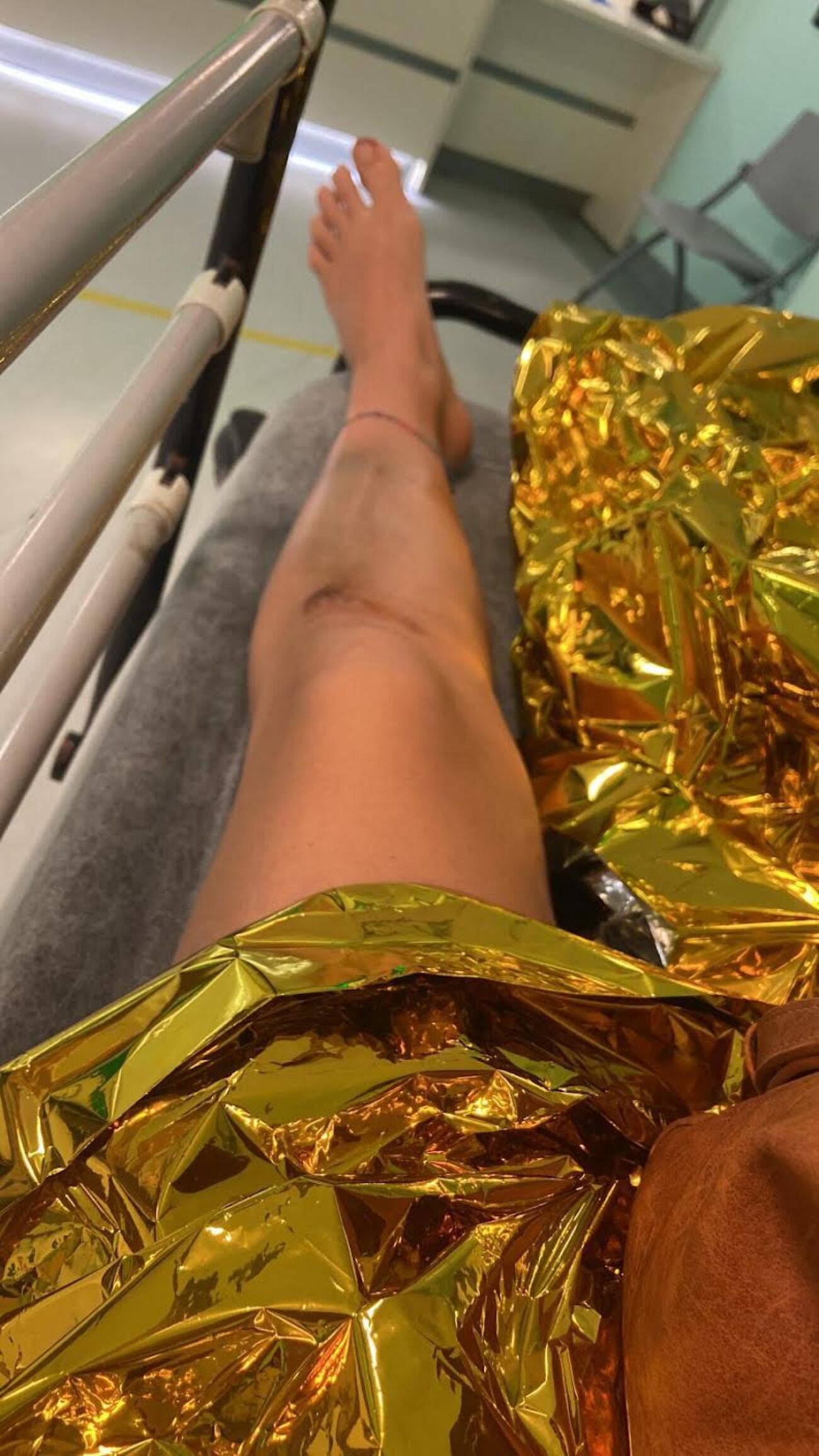 La mia gamba ferita dopo una caduta nel tombino, a Caucana