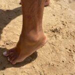 Ecco il morso di un pesce predatore al lido Micenci a Donnalucata