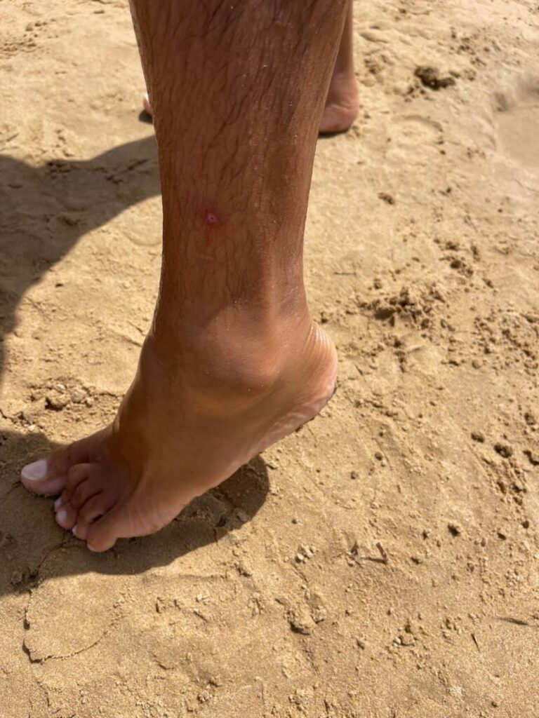 Ecco il morso di un pesce predatore al lido Micenci a Donnalucata