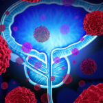 Carcinoma della prostata, Modica diventa centro specialistico