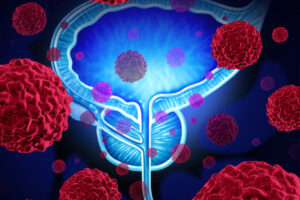 Carcinoma della prostata, Modica diventa centro specialistico