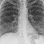 Covid, il 30 per cento dei guariti, avrà problemi cronici ai polmoni