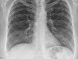 Covid, il 30 per cento dei guariti, avrà problemi cronici ai polmoni