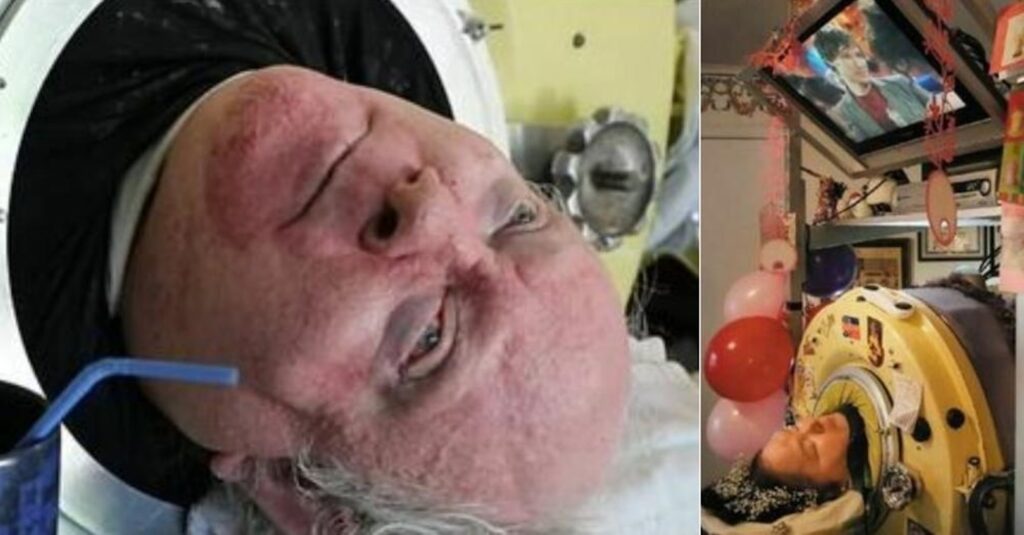 Morto l'uomo che ha vissuto per 70 anni in un polmone d'acciaio