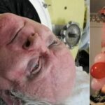 Morto l'uomo che ha vissuto per 70 anni in un polmone d'acciaio