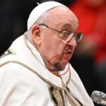 Papa Francesco con un grande livido sotto il mento, ecco l'ematoma