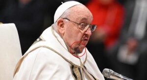 Papa Francesco con un grande livido sotto il mento, ecco l'ematoma