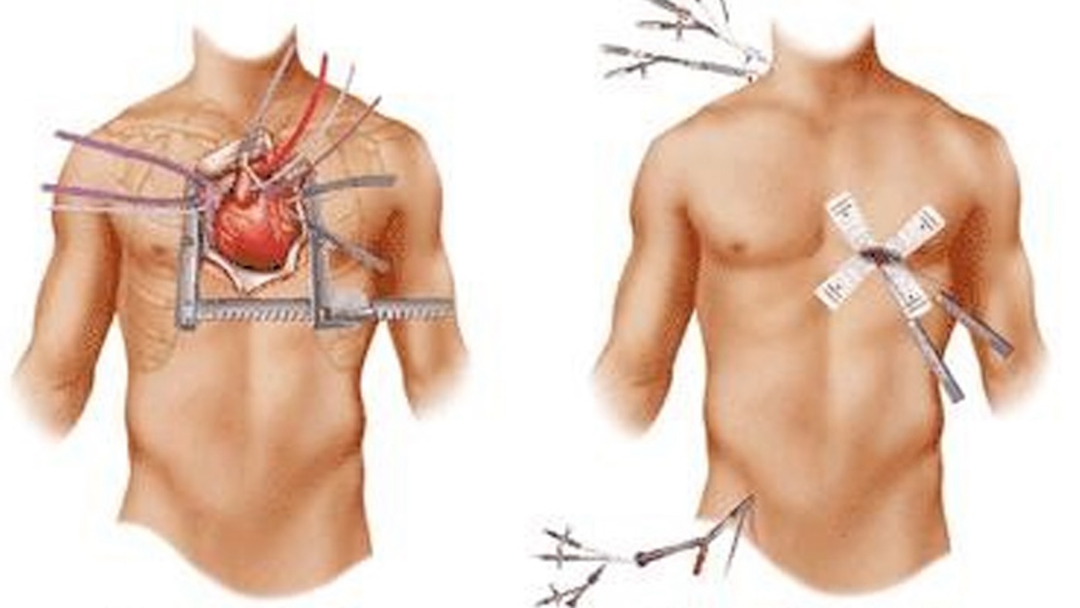 Ragusa, eseguito il primo intervento di riparazione percutanea della valvola mitrale edge to edge